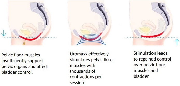 Chronic Pain Round Rock TX Pelvic Floor Graph